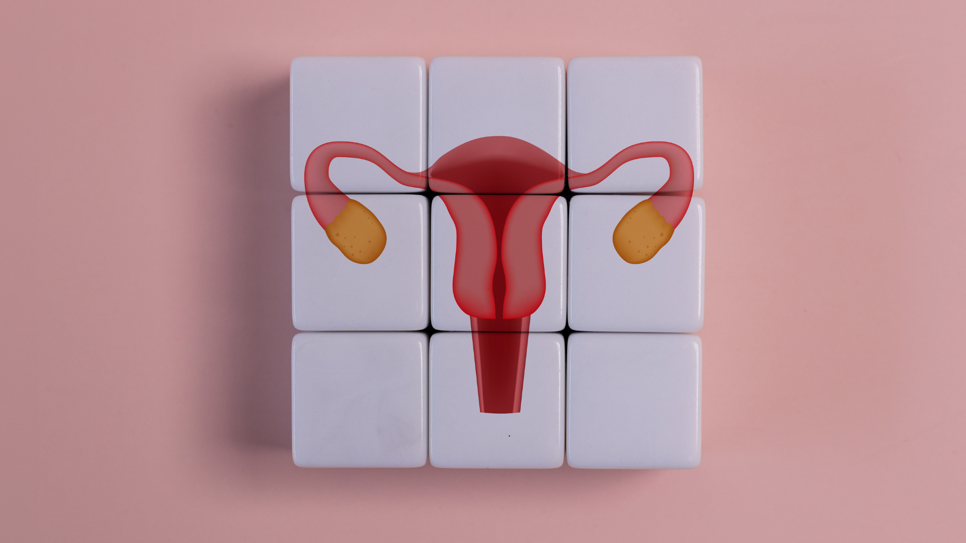 Illustration of human ovaries and uterus, highlighting the reproductive system affected by Polycystic Ovary Syndrome (PCOS)